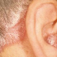 Well-demarcated erythema and scale, usually with normal scalp inbetween. Hairline and back of scalp commonly affected, can be widespread