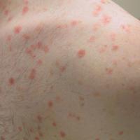 Psoriasis (small) plaque psoriasis - well-demarcated small ruby red plaques with silvery white surface scale