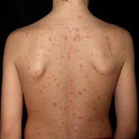 Pityriasis rosea - oval dull-pink macules-patches, some of which have a fine peripheral collarette of scale