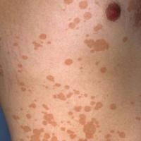 Pityriasis versicolor - fawn-coloured in lighter skin types