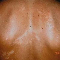 Pityriasis versicolor - paler lesions in skin of colour