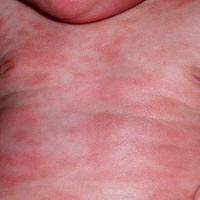 Atopic eczema 2001