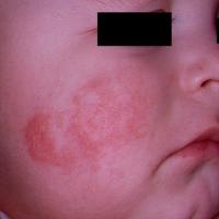 Atopic eczema
