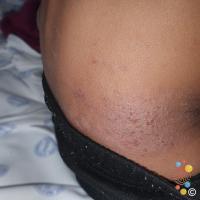 Atopic eczema
