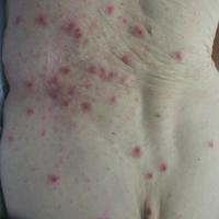 Scabetic nodules
