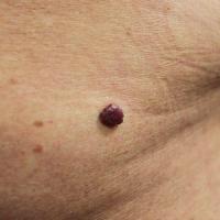 Angioma