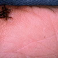 
	Tripe palms associated with carcinoma of the…