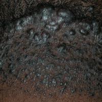 
	Acne keloidalis nuchae 

	Copied with kind…