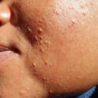Acne with closed comedones
Copied with kind…