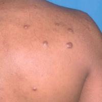 
	Keloid scars

	&nbsp;