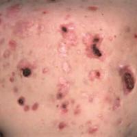 Atrophic scars
Copied with kind permission from…