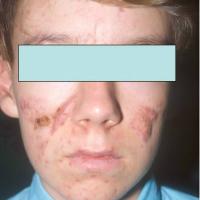 
	Severe inflammatory acne nodules now…