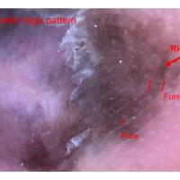 Acral lentiginous melanoma