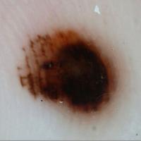 Acral lentiginous melanomaAn eccentric black…