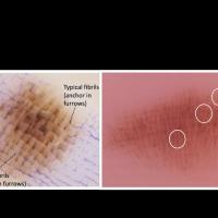 Fibrillar comparisonBenign acral naevus (left…