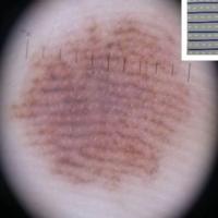 Benign melanocytic naevus - parallel furrow…