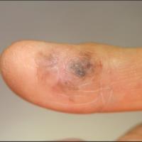 Acral lentiginous melanoma