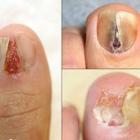 Amelanotic melanomaCopied with kind permission…