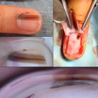 Nail matrix melanoma with involvement of the…