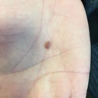 Benign melanocytic naevus - palpableCopied with…