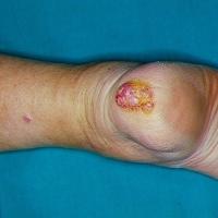 Acral lentiginous melanoma - amelanotic (ie…