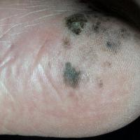 Acral lentiginous melanoma with blotchy…