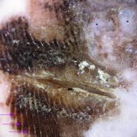 Dermoscopic appearance of previous…