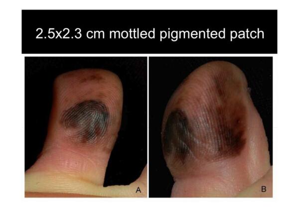 Acral lentiginous Melanoma acral-lentiginous-melanoma
