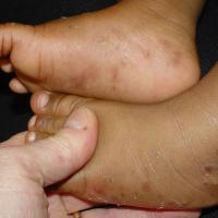 
	Acropustulosis of infancy