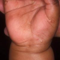 
	Acropustulosis of infancy