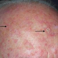 Actinic keratoses with field changeField change…