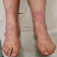 
	Actinic prurigo
	
	This 38 year old woman had…