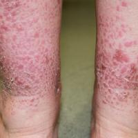 
	Actinic prurigo - same patient as figure 2,…