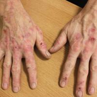 
	Pseudoporphyria secondary to naproxen