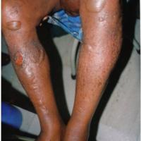 
	A bullous reaction secondary to metronidazole