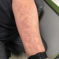 Lichenoid drug reaction to quinine - same case…