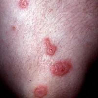 
	Erythema multiforme