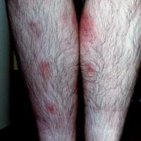 
	Erythema nodosum