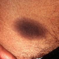 
	Post-inflammatory hyperpigmentation post FDE
