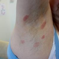 
	Fixed drug eruption (FDE) to tramadol