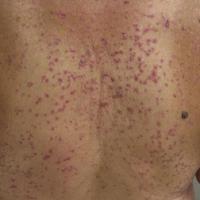 
	Lichenoid drug eruption
