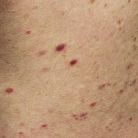 
	Lichenoid drug eruption caused by tramadol 