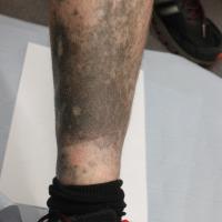 
	Minocycline pigmentation

	The minocycline was…