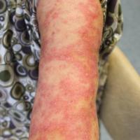 
	Subacute cutaneous lupus erythematosus&nbsp;