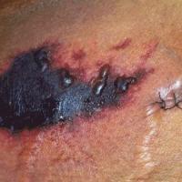 
	Warfarin-induced necrosis 

	&nbsp;