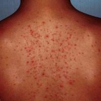 
	Acneiform rash caused by anabolic steroids
