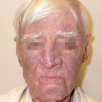 
	Hyperpigmentation caused by amiodarone