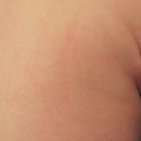 
	An urticated papular erythema

	Erythema and…