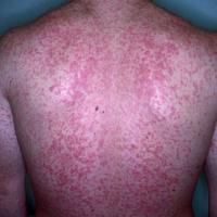 
	Exanthematous rash