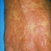 
	Close up of a morbilliform rash (exanthematous)…